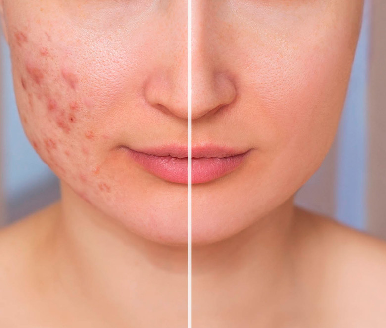 Tratamiento ACNÉ facial. Torrejón de Ardoz LASER HAIR
