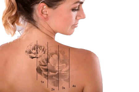 Eliminar tatuaje antiguo LASER HAIR Torrejón MADRID