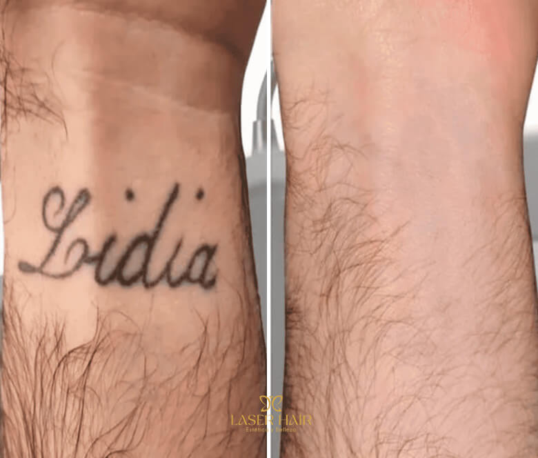 Eliminación tatuajes pequeños Torrejón de Ardoz Madrid en Laser Hair
